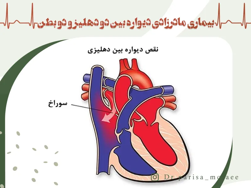 بیماری مادرزادی دیواره بین دو دهلیز 