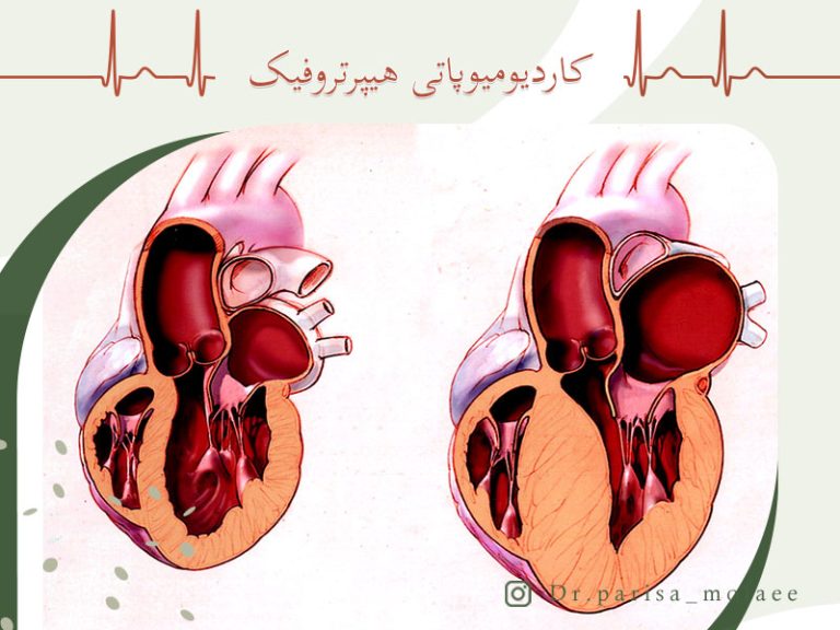 درباره-کاردیومیوپاتی-هیپرتروفیک