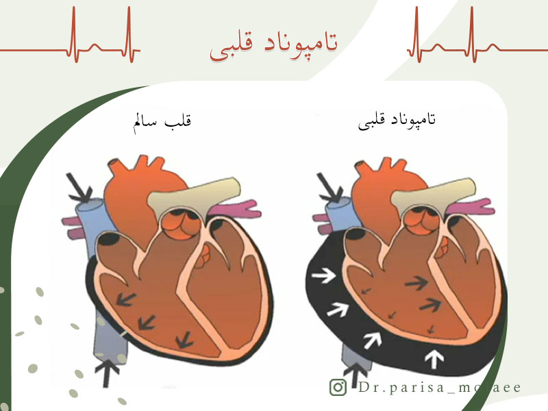 تفاوت-قلب-سالم-و-تامپوناد-قلبی