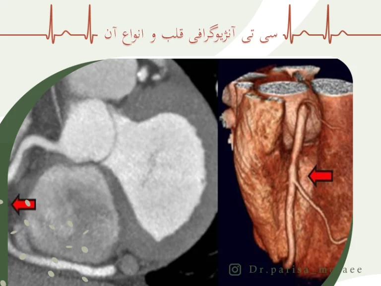 سی تی آنژیوگرافی قلب و انواع آن