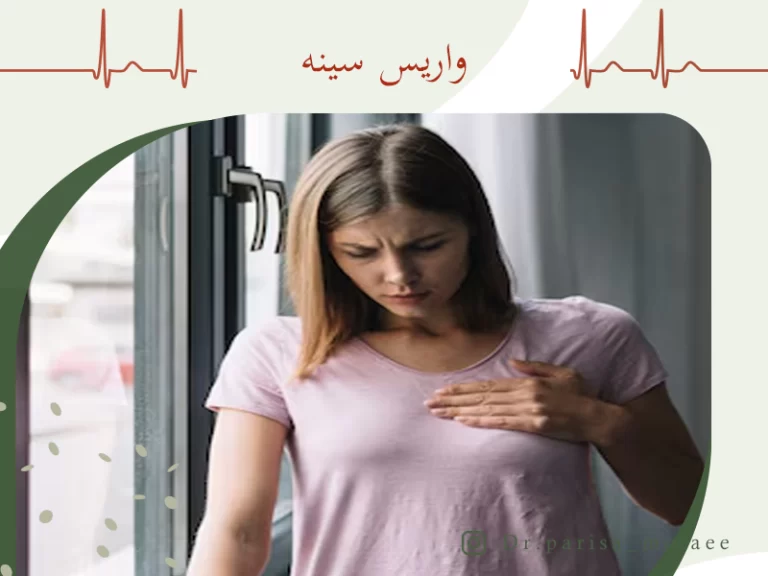 درباره واریس سینه