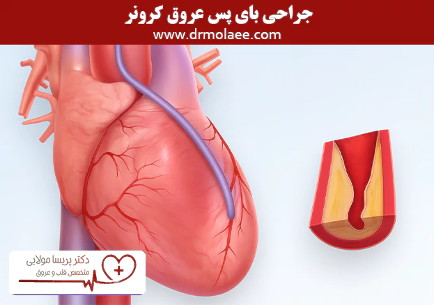 جراحی بای پس عروق کرونر