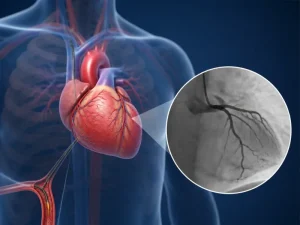 آنژیوگرافی عروق کرونر برای بررسی رگهای قلب
